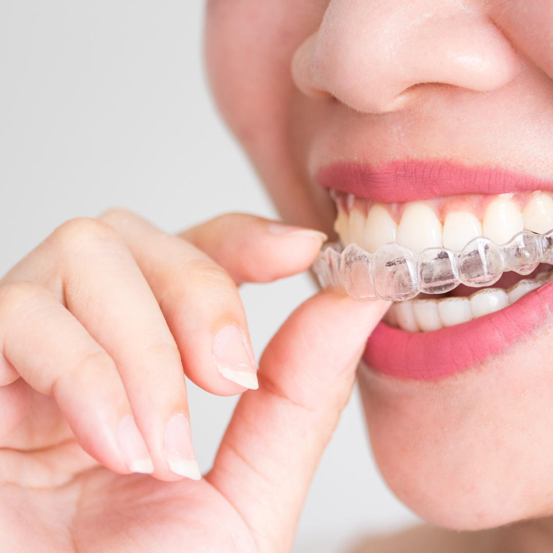 Invisalign image